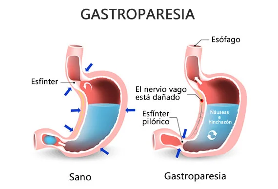 Gastroparesia