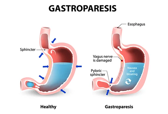 Gastroparesis
